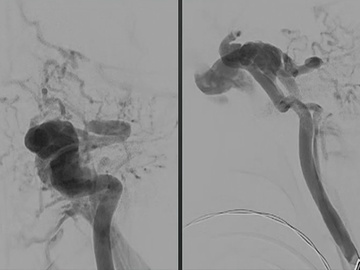 XCalibur aneurysm occlusion device in treatment of direct carotid cavernous fistula