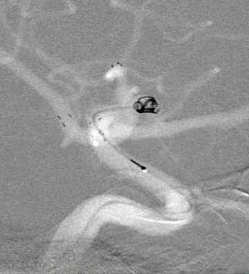 Y-Stent-assisted coiling for Left MCA bifurcation aneurysm