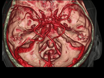 Y-stentriever" thrombectomy: dealing with a hard clot in basilar tip occlusion