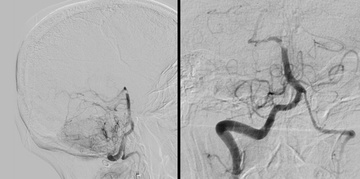 Y-stentriever" thrombectomy: dealing with a hard clot in basilar tip occlusion