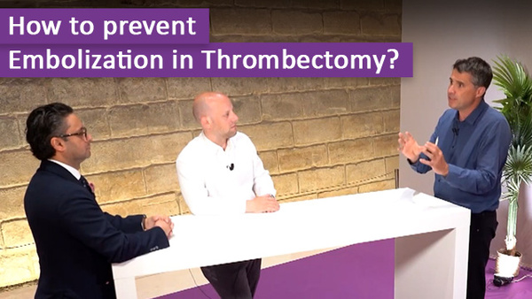 Confronting embolization in thrombectomy: confirmations and revelations.