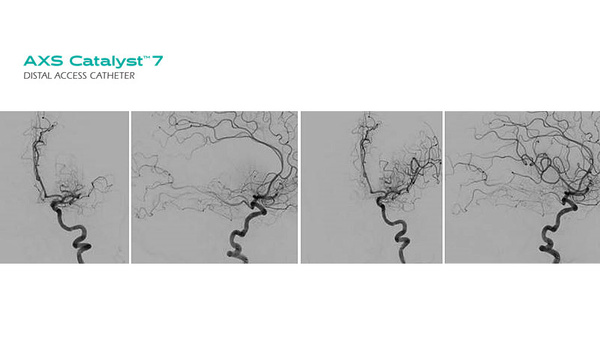 First European experience with the AXS Catalyst 7 Distal Access Catheter