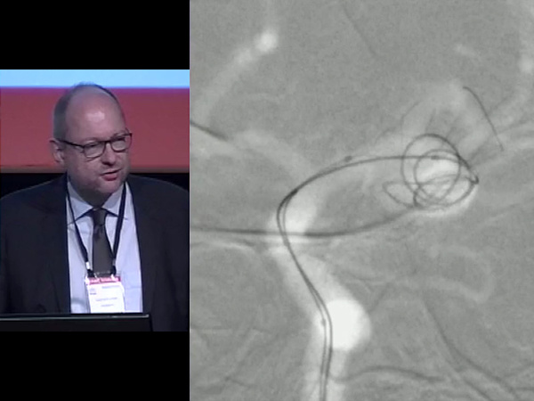 LEO+ Baby in 55 complex Aneurysms: Initial and 6-month angiographic Follow-Up results in a single center series 
