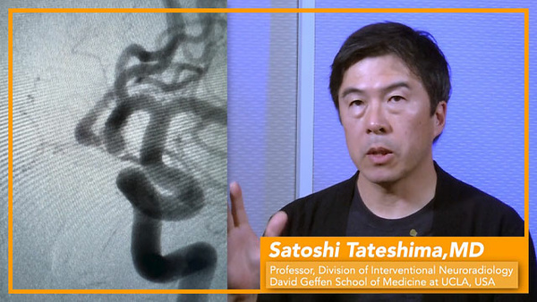 Dr. Tateshima's initial clinical experience using  Target Tetra® Detachable Coils