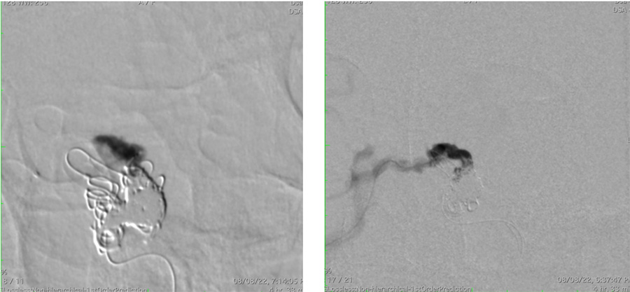 Management of complex CCF case