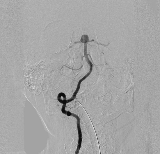 basilar artery aneurysm