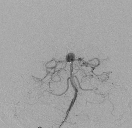 basilar artery aneurysm 3