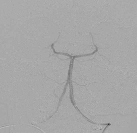 Basilar artery aneurysm - web-device