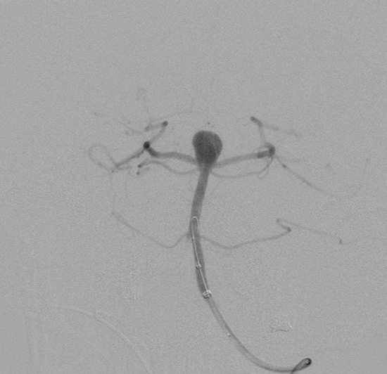 Basilar artery aneurysm