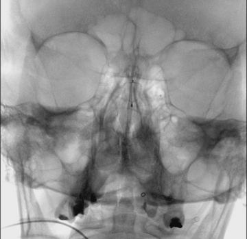 Bolus dose of integrilin