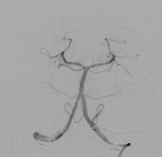 Control angiogram