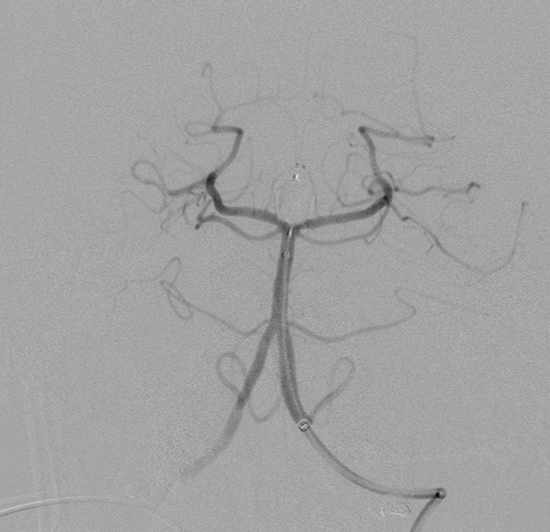 Neuromax into vert
