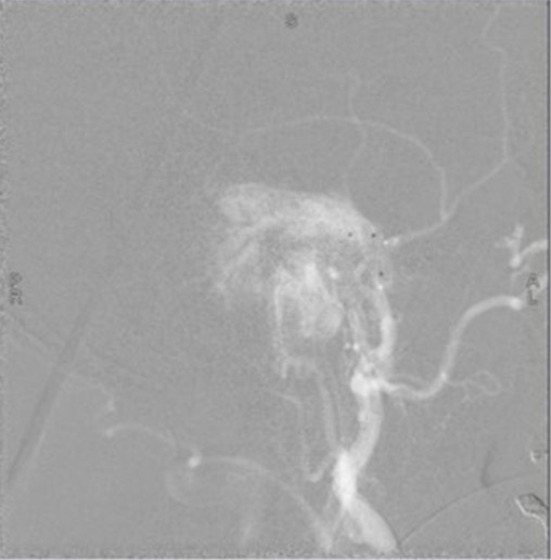 left tympanic glomus