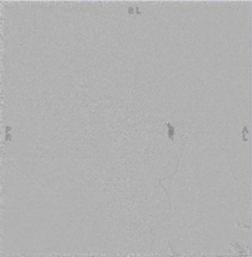 left tympanic glomus