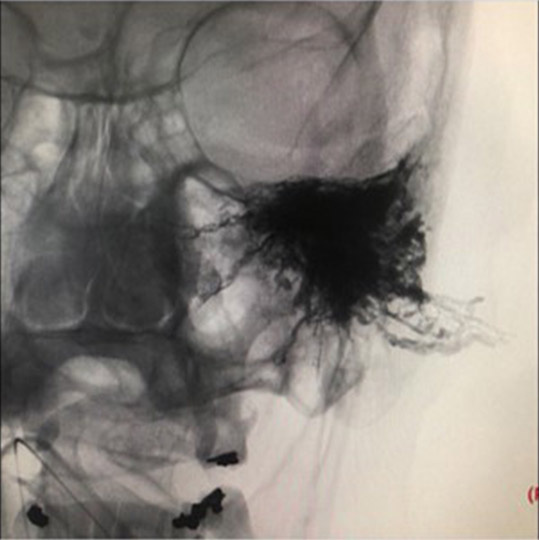 left tympanic glomus