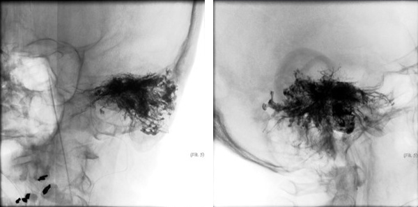 left tympanic glomus