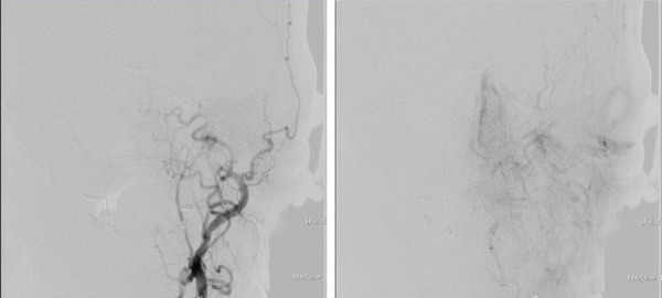 left tympanic glomus