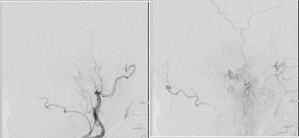 left tympanic glomus