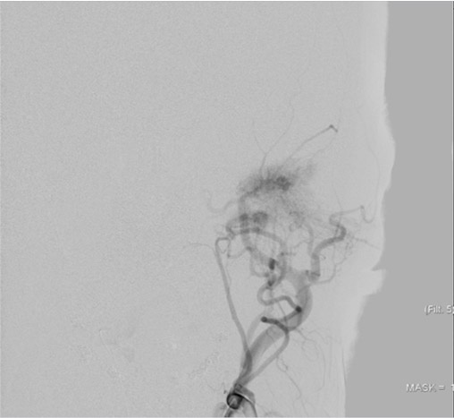 left tympanic glomus
