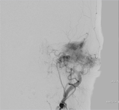 left tympanic glomus