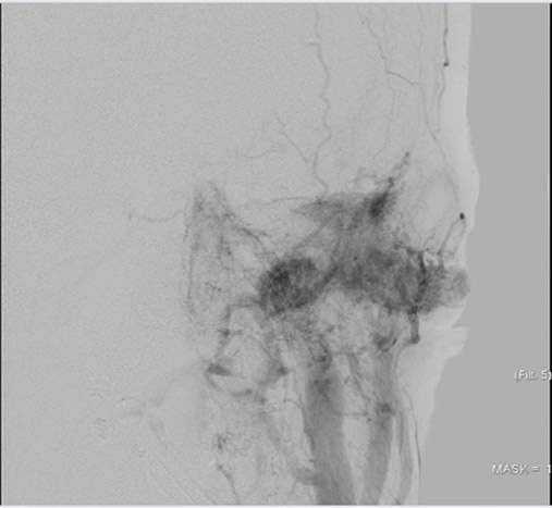 left tympanic glomus