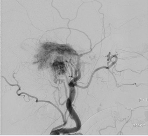 left tympanic glomus