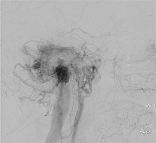 left tympanic glomus