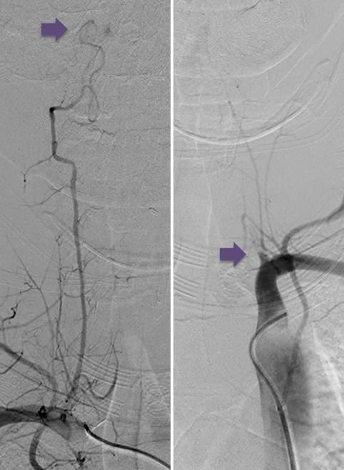 angio-occlusion