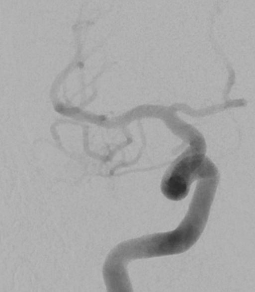 arterial-feeders