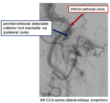 arterialized-sigmoid-sinus-collector