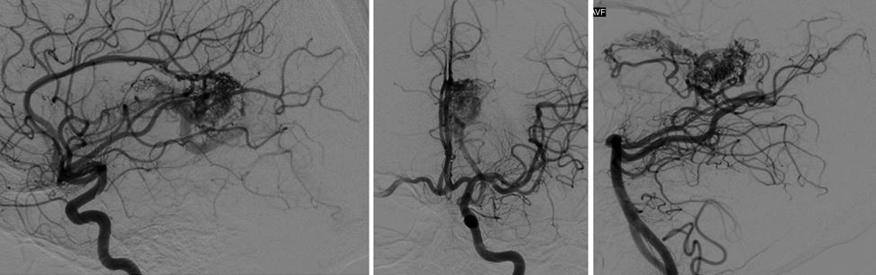 choroidal-AVM