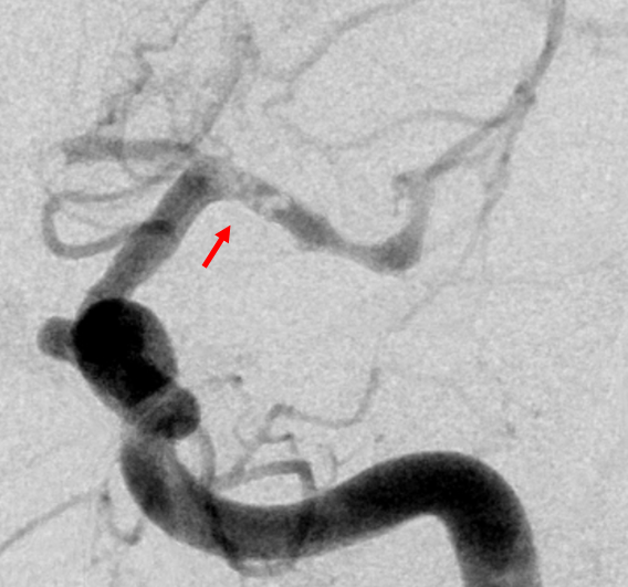 clot-formation