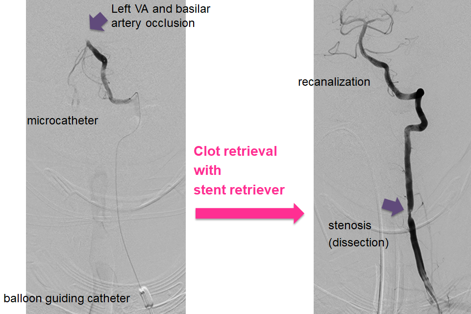 clot-retrieval