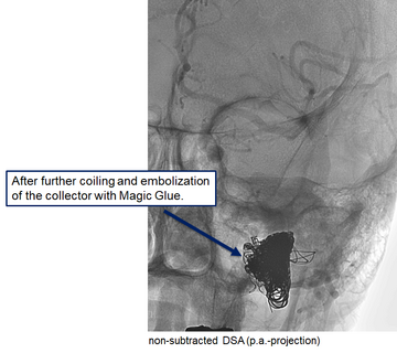 coiling-embolization-collector-magic-glue
