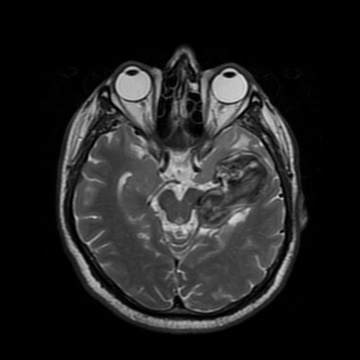 edema-decreased