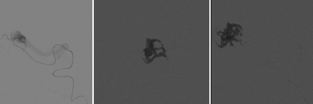 embo-pedicle-onyx