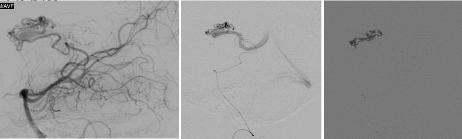 embolization-session2