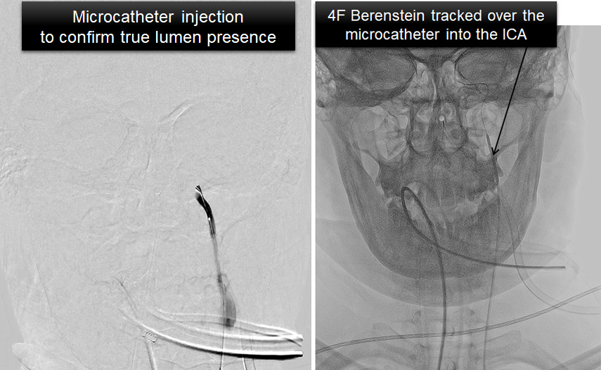 inject-berenstein