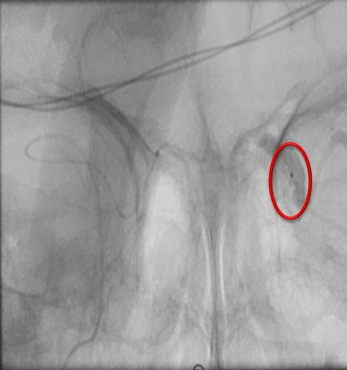 lcs-venogram
