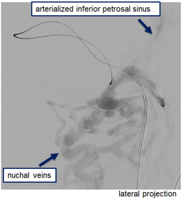 left-sigmoid-sinus-compartment-draining-davf