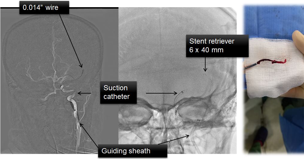 mechanical-thrombectomy