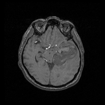 mesencephalon-compression