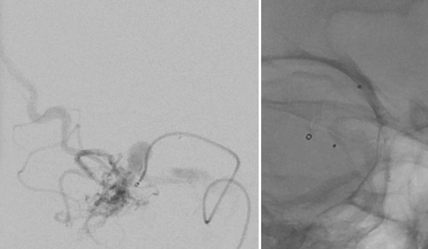microcatheter-injection