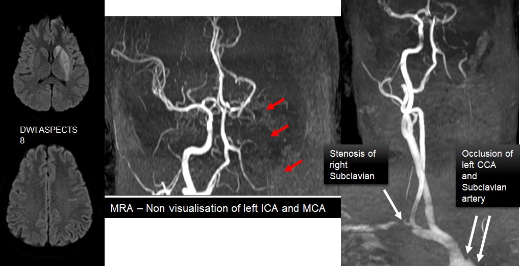 mra-occlusion