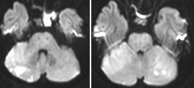 MRI-after