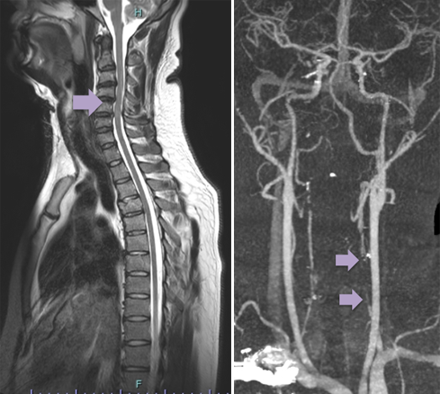 MRI-angio