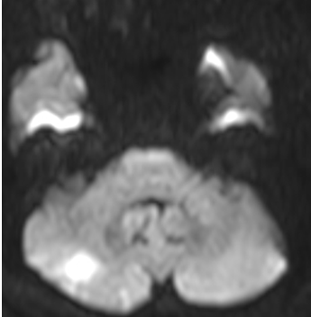 mri-before