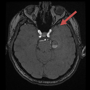 partial-thrombosed-gsa-2