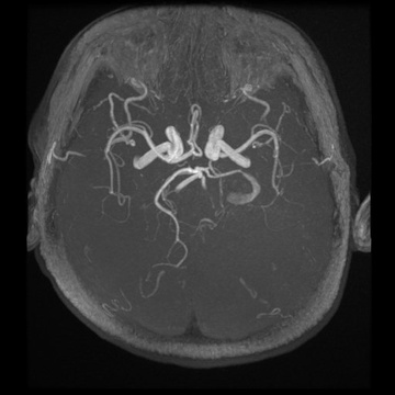 partial-thrombosed-gsa