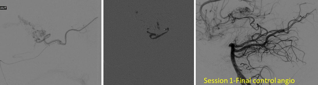 pedicle04